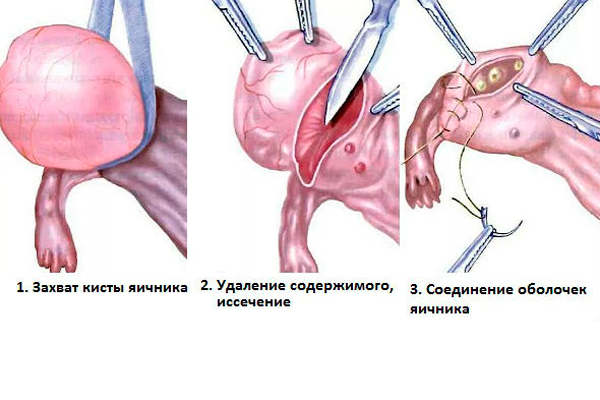 Мультикистоз яичника в следствии операции по удалении кисты