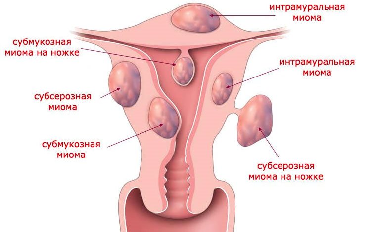миома матки в стадии регресса при климаксе