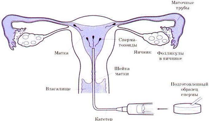 внутриматочная инсеминация спермой мужа