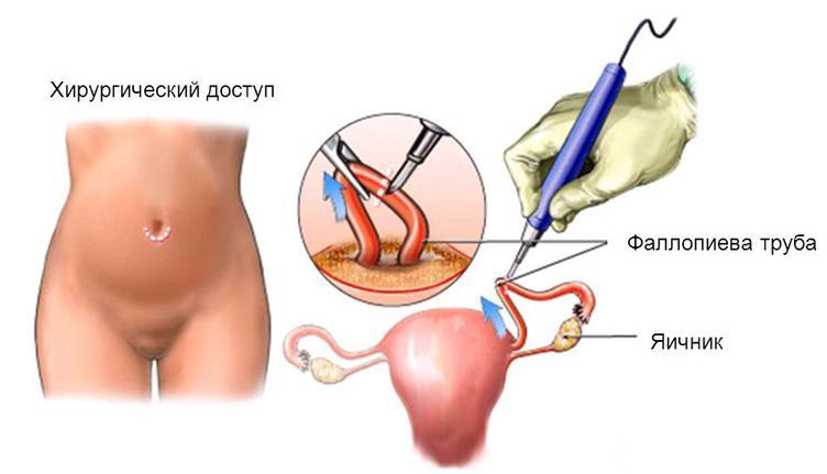 Женская стерилизация как метод контрацепции