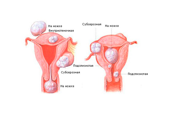 Применение Диферелина при фибримиомы матки
