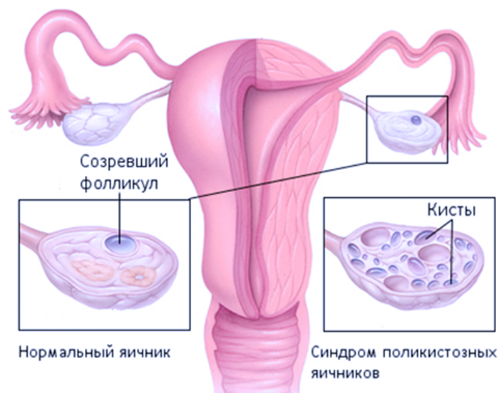 Отличие яичников при поликистозе и нормой