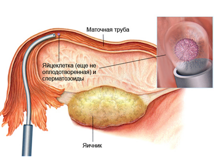Как проходит подсадка оплодотворенного эмбриона в полость матки при длинном протоколе
