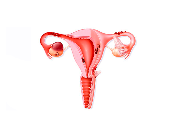 Эндометриоз матки, как причина анализа на гормон ФСГ