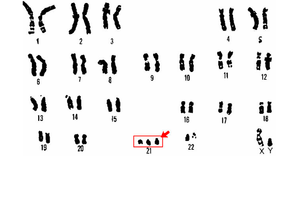 Проведения амниоцентеза из-за возможного наличия лишней 21-й пары хромосом