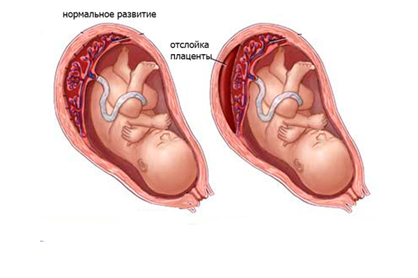 Возможное отслоение стенки плаценты от матки на 33-й недели беременности