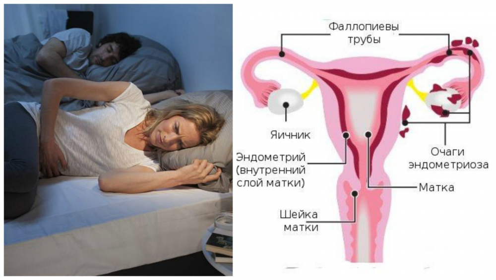 эндометриоз матки при климаксе симптомы и лечение