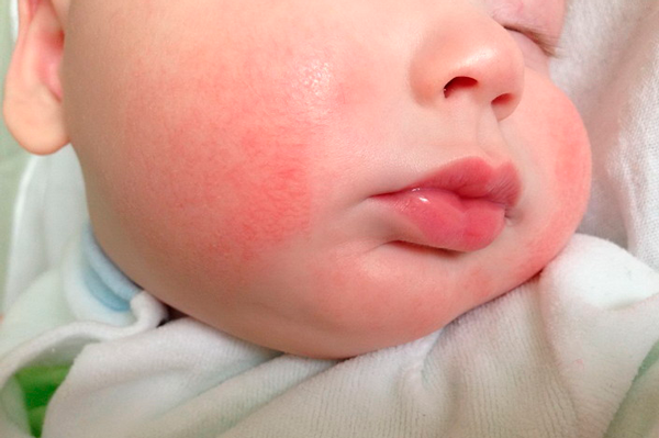 Возможная аллергия у новорожденного в следствии злоупотребления халвой при беременности