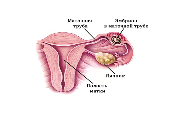 Схема внематочной беременности