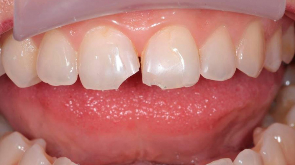 Почему крошатся зубы? И как уберечь живые зубы от разрушений?