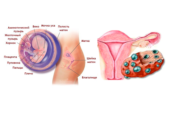 При поликистозе можно забеременеть. Склерокистоз яичников зачатие. Синдром поликистоза яичников. Беременность с поликистозом яичников. Забеременеть при поликистозе яичников.