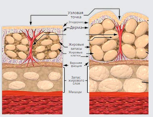 ТОП-8 процедур, которые уберут лишние сантиметры: как быстро визуально улучшить кожу и скрыть целлюлит
