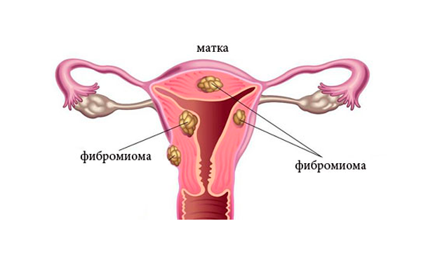 Проведение фолликулометрии при фибромиоме матки