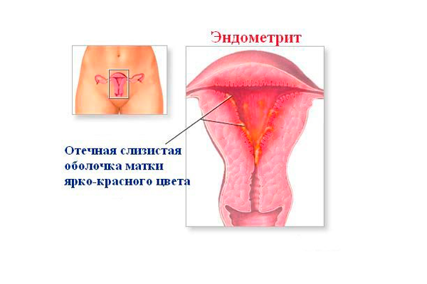 Приобретенное женское первичное бесплодие в лице эндометрита