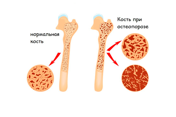 Остеопороз при гипофункции яичников