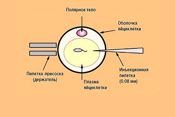 Процедура ИКСИ для осуществления зачатия при секреторном бесплодии у мужчины