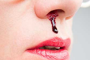кровь носом при беременности