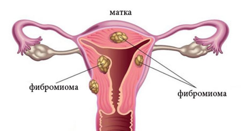 Фибромиома матки: симптомы и признаки, лечение, беременность ...