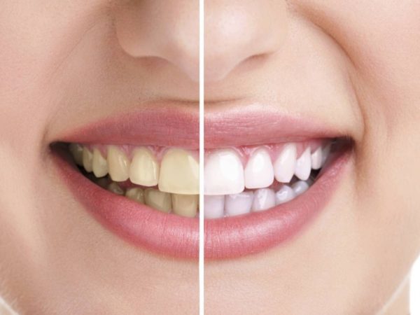 После отказа от курения восстановится цвет зубов