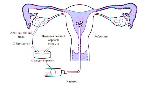 Процесс криопереноса эмбрионов