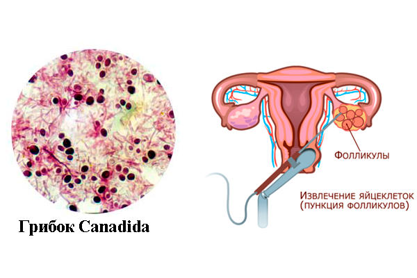 Появление молочницы из-за медицинских манипуляция процедуры ЭКО
