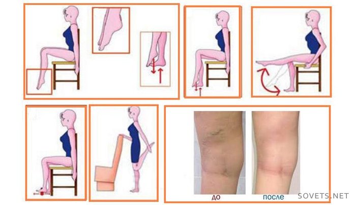 Варикоз на ногах лечение, профилактика и причина варикоза,закупорка вен