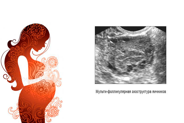 Возможная беременность при синдроме мультифолликулярных яичников