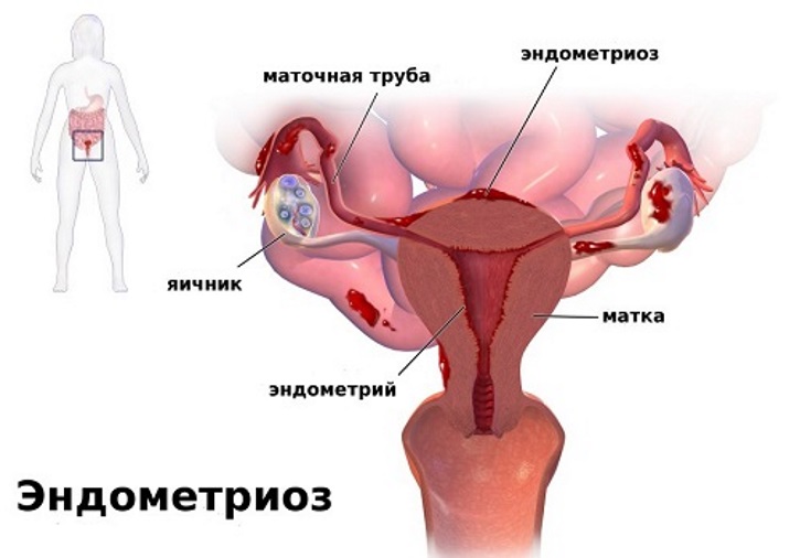 Лечение эндометриоза у женщин после 40 лет: симптомы, диагностика, меры